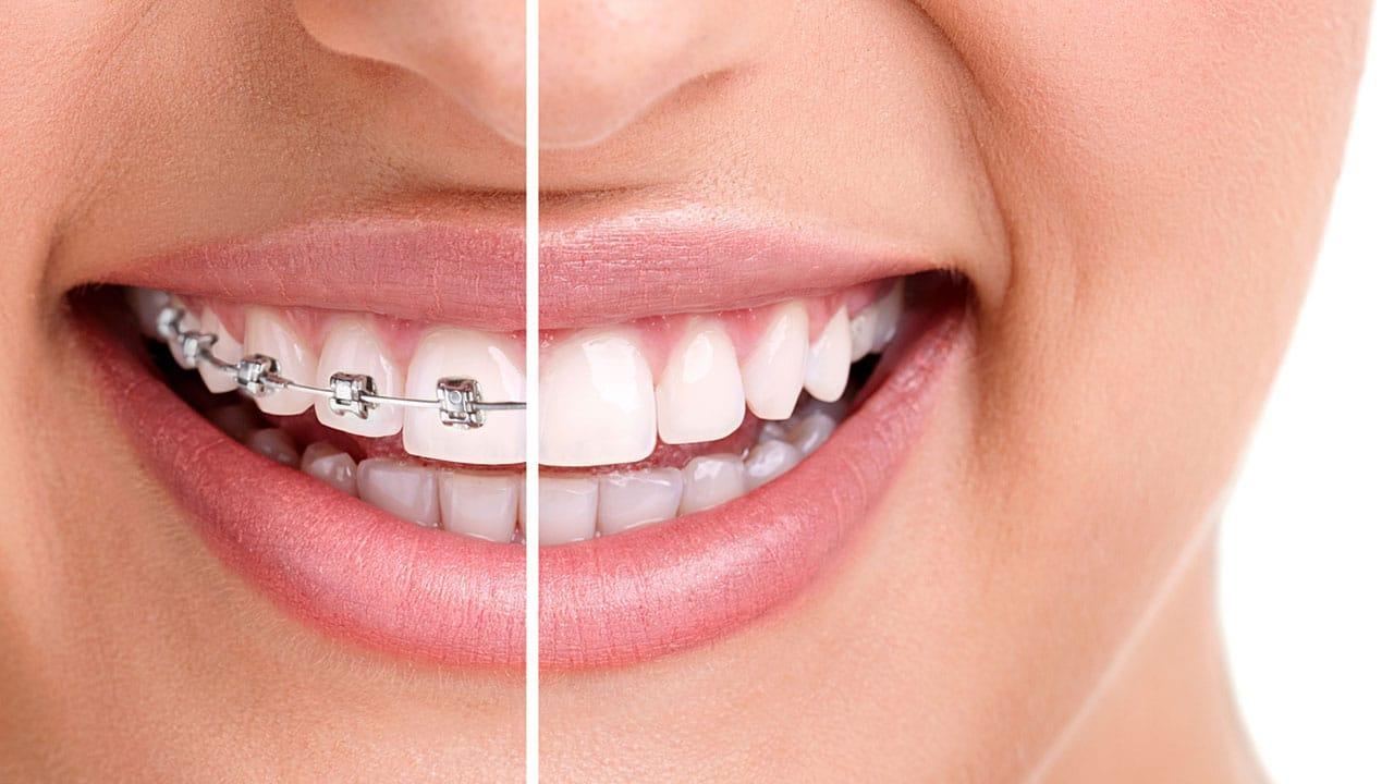 Why Does Orthodontic Treatment Hurt?