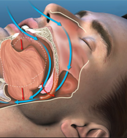 The Sound of Silence: CPAP Machines as Anti-Snoring Devices
